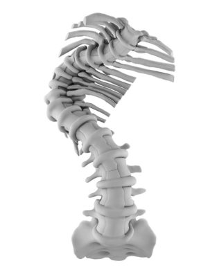 130 degree Lenke 1 curve with autofusing at the apex