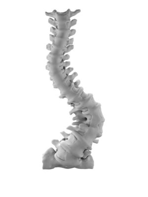 Adult Idiopathic Degenerative Thoracolumbar Scoliosis Apex L2