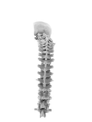 Chin-On-Chest Deformity 2