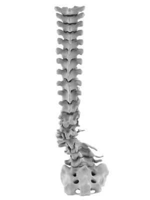 Congenital lumbar deformity 1