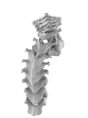 Pediatric Thoracic Focal Deformity