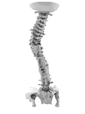 Fixed Thoracolumbar Deformity With Dysmorphic Pelvis