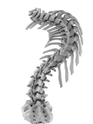 Early Onset Scoliosis 120 Degrees Apex T8