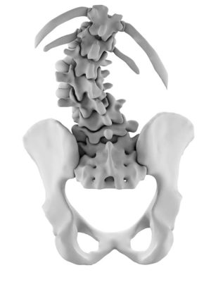 Lumbar Degenerative Scoliosis with Bertolotti's Joint