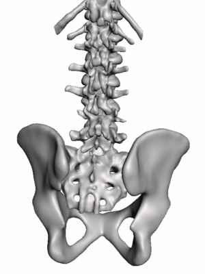 Spondylolisthesis 2
