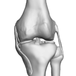 Varus Knee - 10 Degree Deformity $0.00