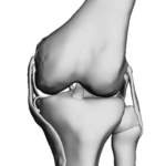 Valgus Knee - 15 Degree Deformity $0.00