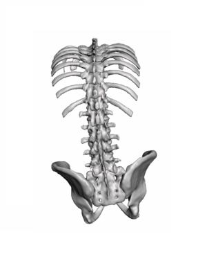 90 Degree Scheurmann Kyphosis