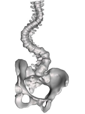AIS Type 4C Severe