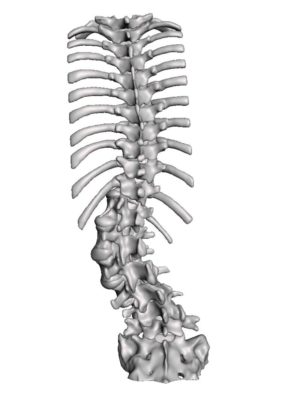 Adult Upper Lumbar Mobile Kyphoscoliosis