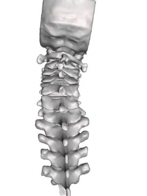 C5-C6 Focal Kyphosis