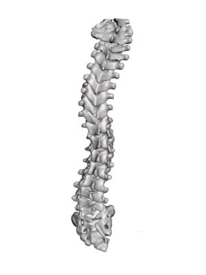 Cervical, Thoracic & Lumbar Hemivertebrae