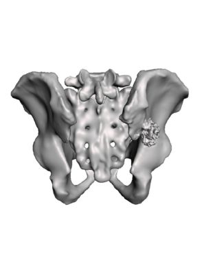 Iliac Wing Tumor