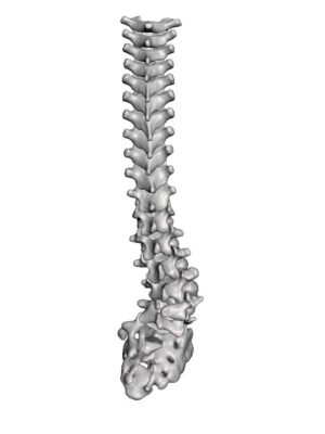 L4 Hemivertebrae