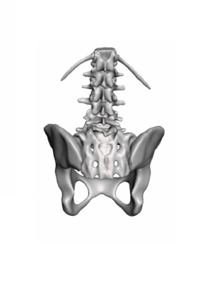 L5-S1 Spondyloptosis