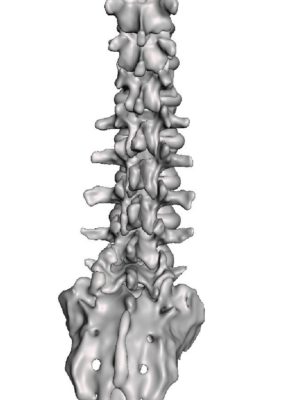 Lumbar Facet Arthropathy