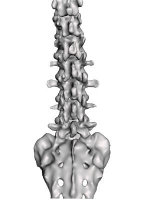 Lumbar Mild Spondylosis