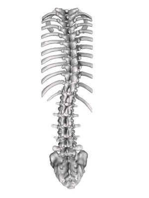 Mild AIS Type 1A