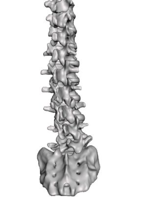 Moderate Thoracolumbar Spondylosis & Osteophytic Spurring