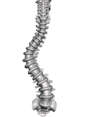Occiput to Sacrum with AIS Type 1A