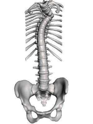 T5 Congenital Deformity with Focal Kyphoscoliosis