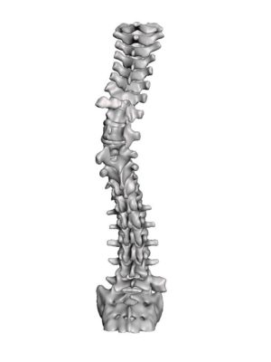 T8 Focal Congenital Kyphosis