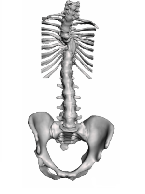 T8-T10 Focal Congenital Kyphosoliosis