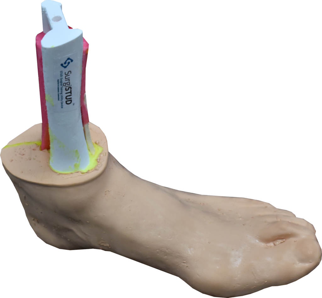 Comprehensive Bunion Foot Cast SurgiSTUD
