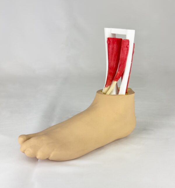 Comprehensive Bunion Foot - Cast