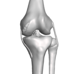 AMOA Knee - 5 Degree Deformity $0.00