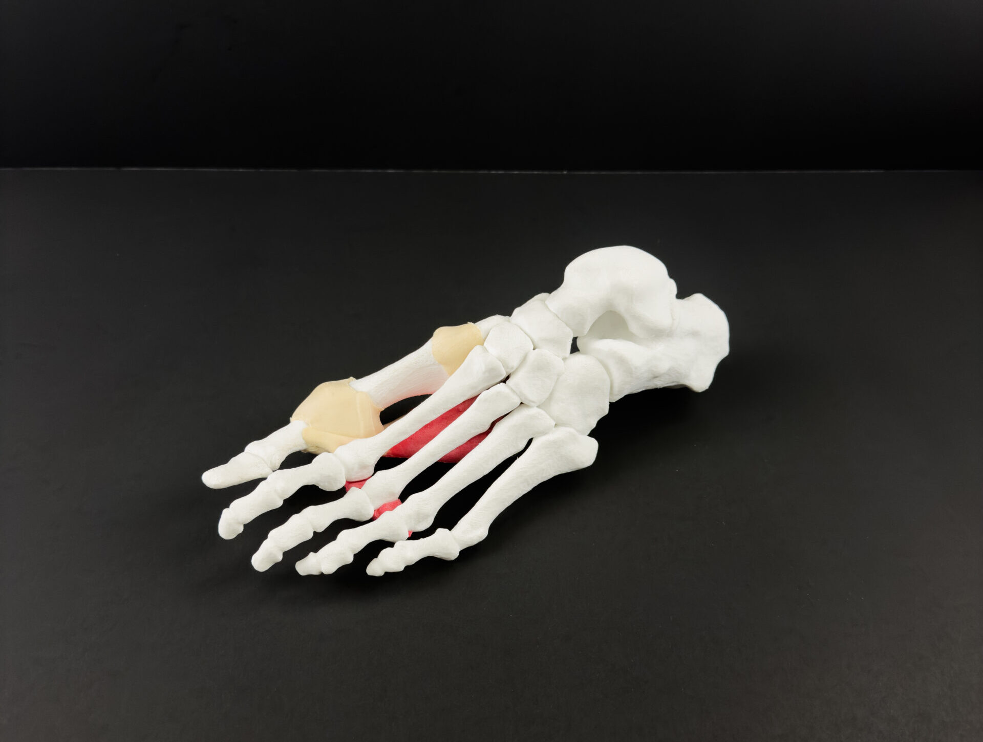 Streamlined Bunion Model - Image 2