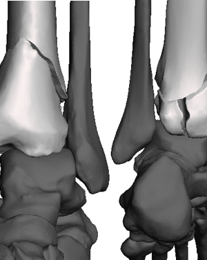 Pilon Fracture Ankle Model